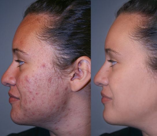 Before &After